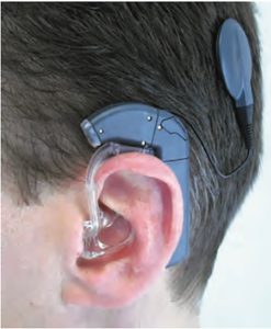 A man with a Cochlear Implant